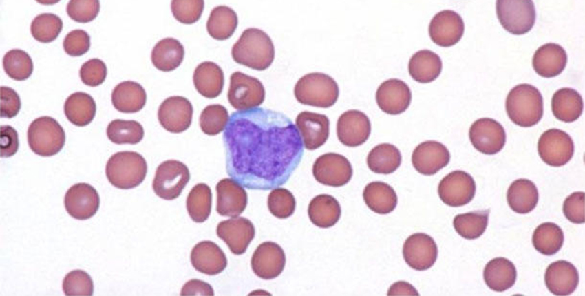 Pink-stained cells on a white background are interrupted by one misshapen purple-stained cell