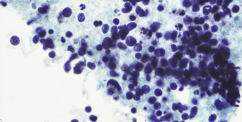 Cancer cells show as purple circles against blue tissue