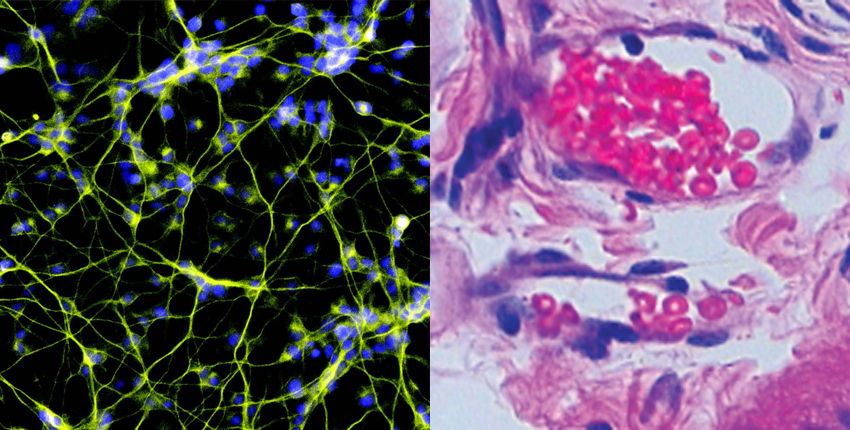 Combined image of two micrographs. On left, web of yellow threads with blue nuclei against a black background. On right, swirls of pink and purple stained cells on a gray background.