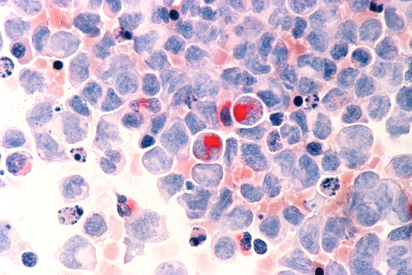 Human cells with acute myelocytic leukemia (AML) in the pericardial fluid, shown with an esterase stain at 400x