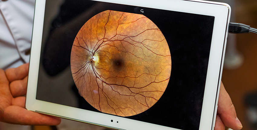 image of ocular funds being presented on an iPad 