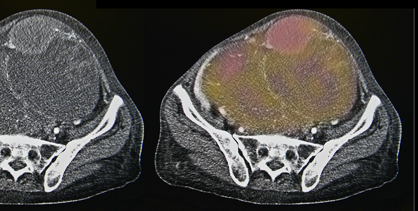 ovarian cancer image