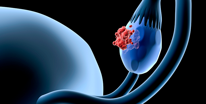 illustration of ovarian cancer