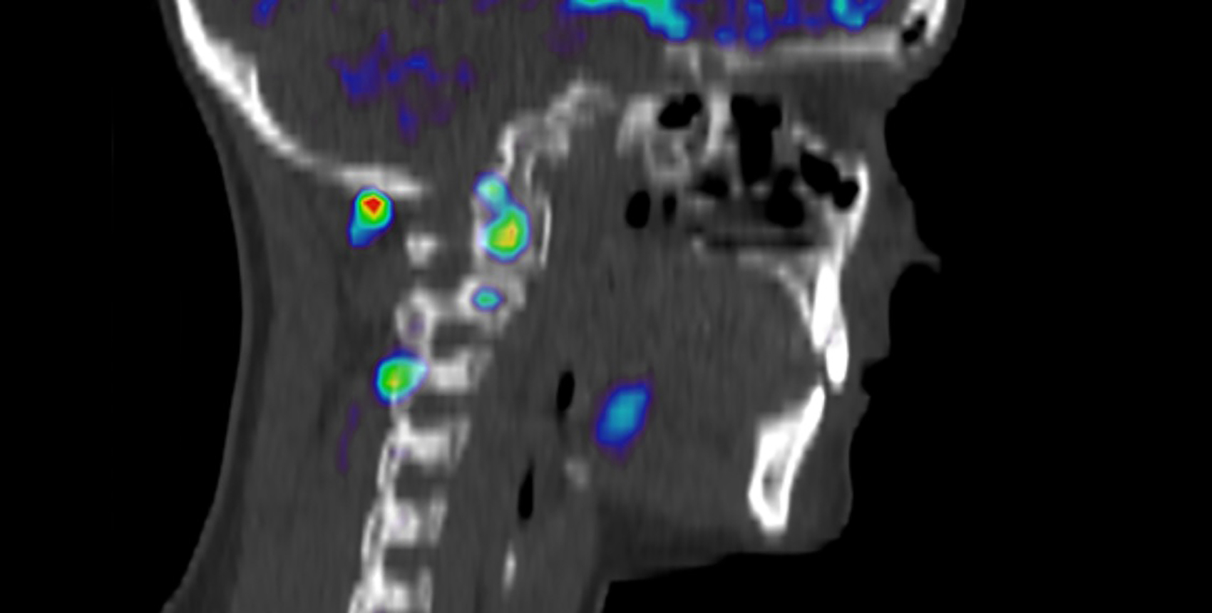 An image of a person’s head and neck showing normal tissue in black and white tones and inflammation in bright colors.