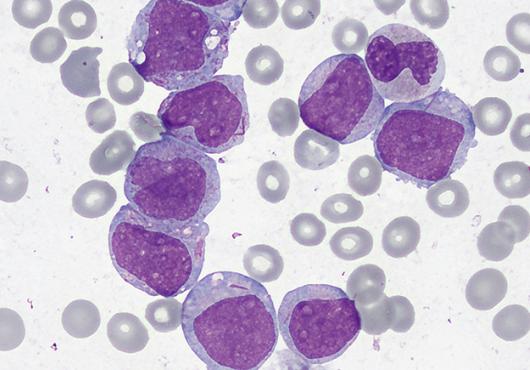 healthy cells shown in gray while cancerous cells are large and stained purple