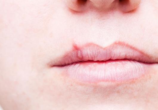 Closeup of a a lip with a cold sore, caused by herpes simplex virus