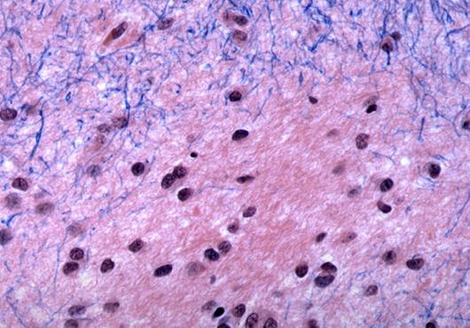 Brain tissue in Huntington’s disease