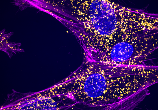 Four cells under a microscope have sweeping lines and round nuclei. Hundreds of tiny yellow dots indicate abnormal RNA molecules.