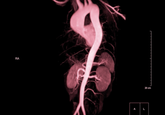 image of a red aorta against a black background