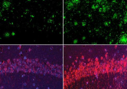 One pair of boxes shows fewer green amyloid clusters on the left and more on the right. Another pair of boxes shows a dim arc of purple and red tau on the left and a brighter arc on the right.