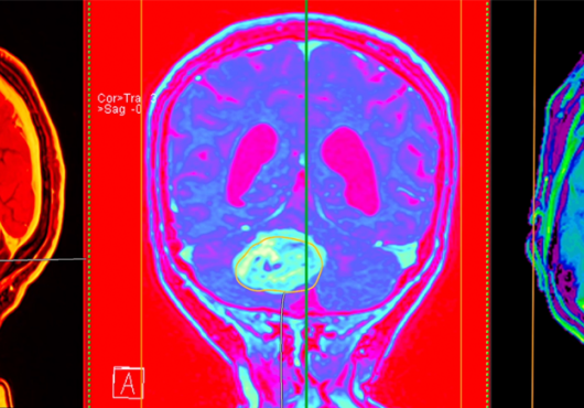 Three vibrantly colored views of a brain MRI showing a large tumor
