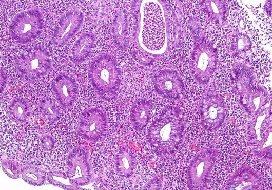 Pink- and purple-stained microscope slide shows normal and diseased features from a patient’s colon.