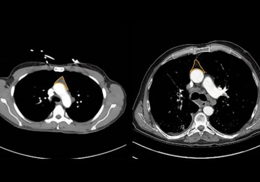 Two side-by-side CT scans of the chest, each of which has a small triangular orange outline in the middle indicating the thymus. One is filled with gray while the other is dark.