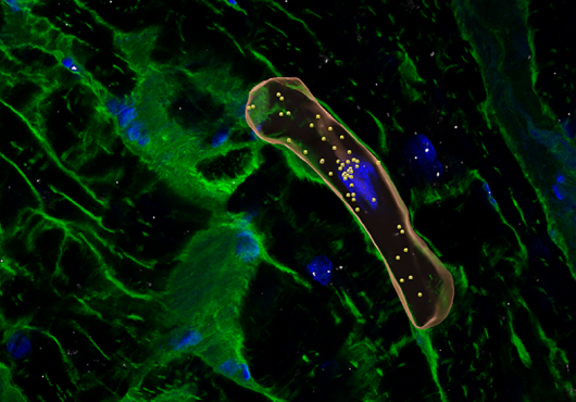 Reconstructed microscope view of cardiac cells labeled in blue and green, from a person with hypertrophic cardiomyopathy. One heart cell is outlined in orange and has many dots inside.