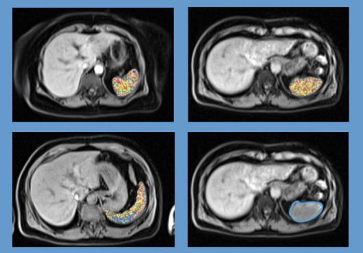 A grid of four abdominal MRI scans, with the spleen outlined in blue or marked by numerous dots added by AI.