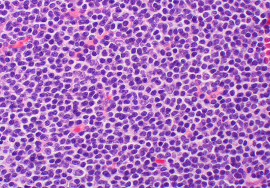 B-cell lymphoma with cells stained purple