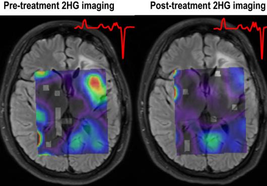 New View of Gliomas