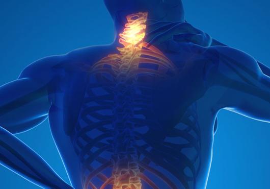 Illustration of human back with areas of inflammation highlighted