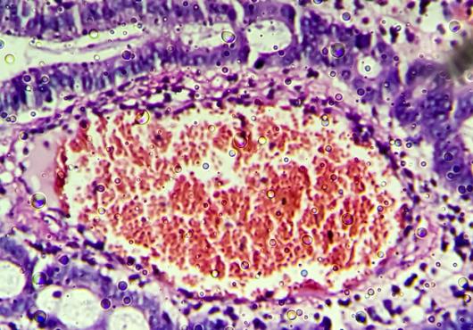 Microscopic image of colonic adenocarcinoma. Image: Md Ariful Islam/iStock/Getty Images Plus