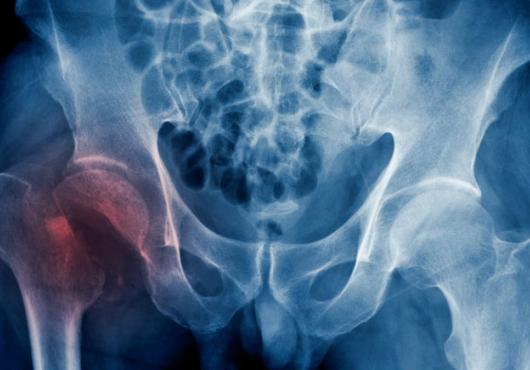 X-Ray image of a human hip with right join reddish colored 