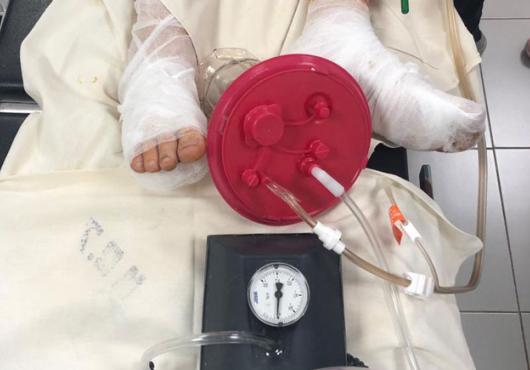 Image of a patient's bandaged feet and a wound therapy pump 