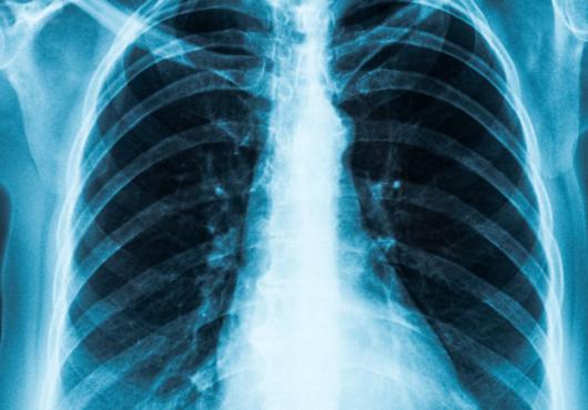 Image of a chest x-ray