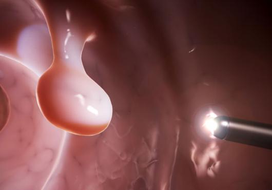 Illustration of a polyp inside of a colon with a laparoscopic light near it 