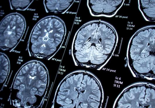Photo of an MRI showing multiple images of a human brain