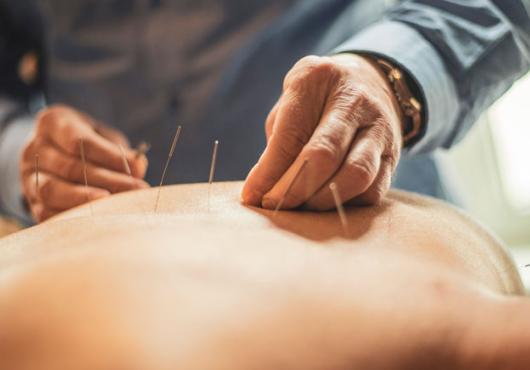 An acupuncturist inserts needles into a patient's back