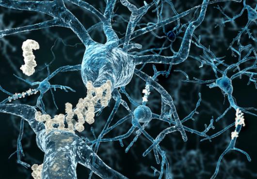 Neurons with amyloid plaques