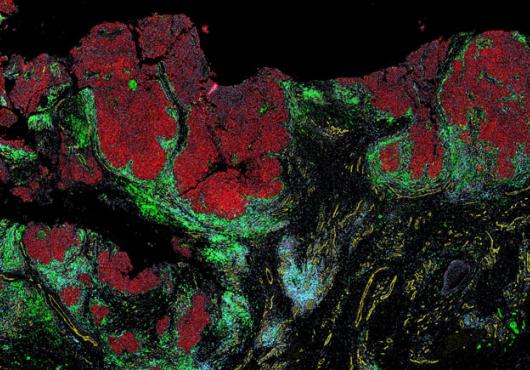 Patches of red melanoma cells surrounded by layers of blue and green immune cells. 