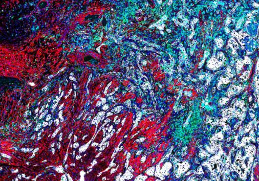A close up image of a lung cancer tumor, composed of patches of red, white, blue, and green cells