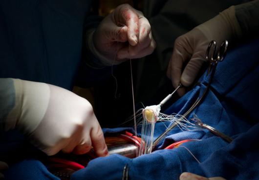 Image of a heart surgery procedure