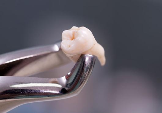 Photo of an extracted tooth