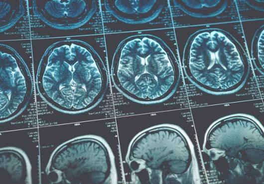 Rows of blue and white brain scans on a black background