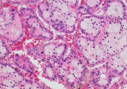 renal cancer cells