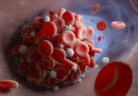 blood clot