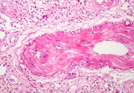 Contracted kidney, light micrograph 