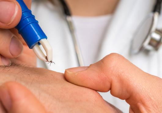 Physician extracting a tick with tweezers 