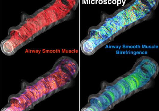 Two kinds of imaging—optical coherence tomorgraphy and mechano-microscopy—reveal airway volume and thickness during an asthma attack (left) and an estimation of the force with which the airway muscle contracts. Image: Mass General