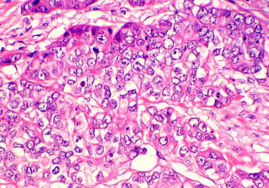 breast cancer cells
