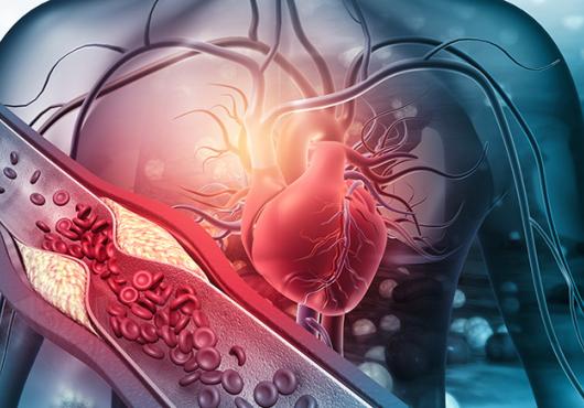 digital image of heart and blocked arterty