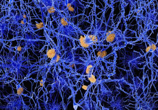 Alzheimer disease, neuron network with amyloid plaques