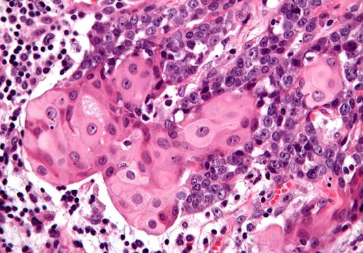 Purple and pink stains show abnormal cells