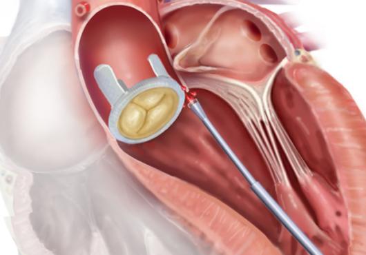Illustration shows a tube entering a heart and approaching a leaky valve