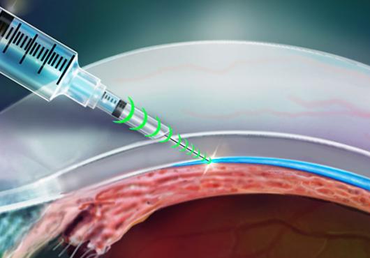 Researchers invent a resistance-sensing injection device that knows where to go