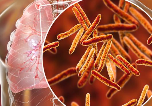 secondary tb in lunch and close-up of tb bacteria