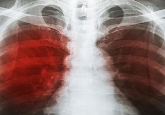 X-ray of infected lungs