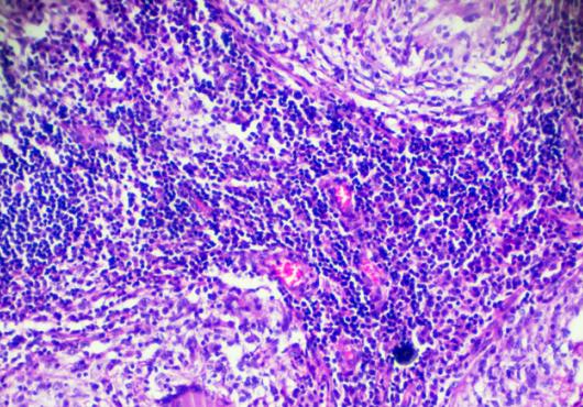 Tuberculosis pathological sample under microscope