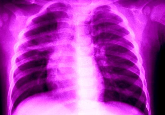 Colorized x-ray image of lungs.